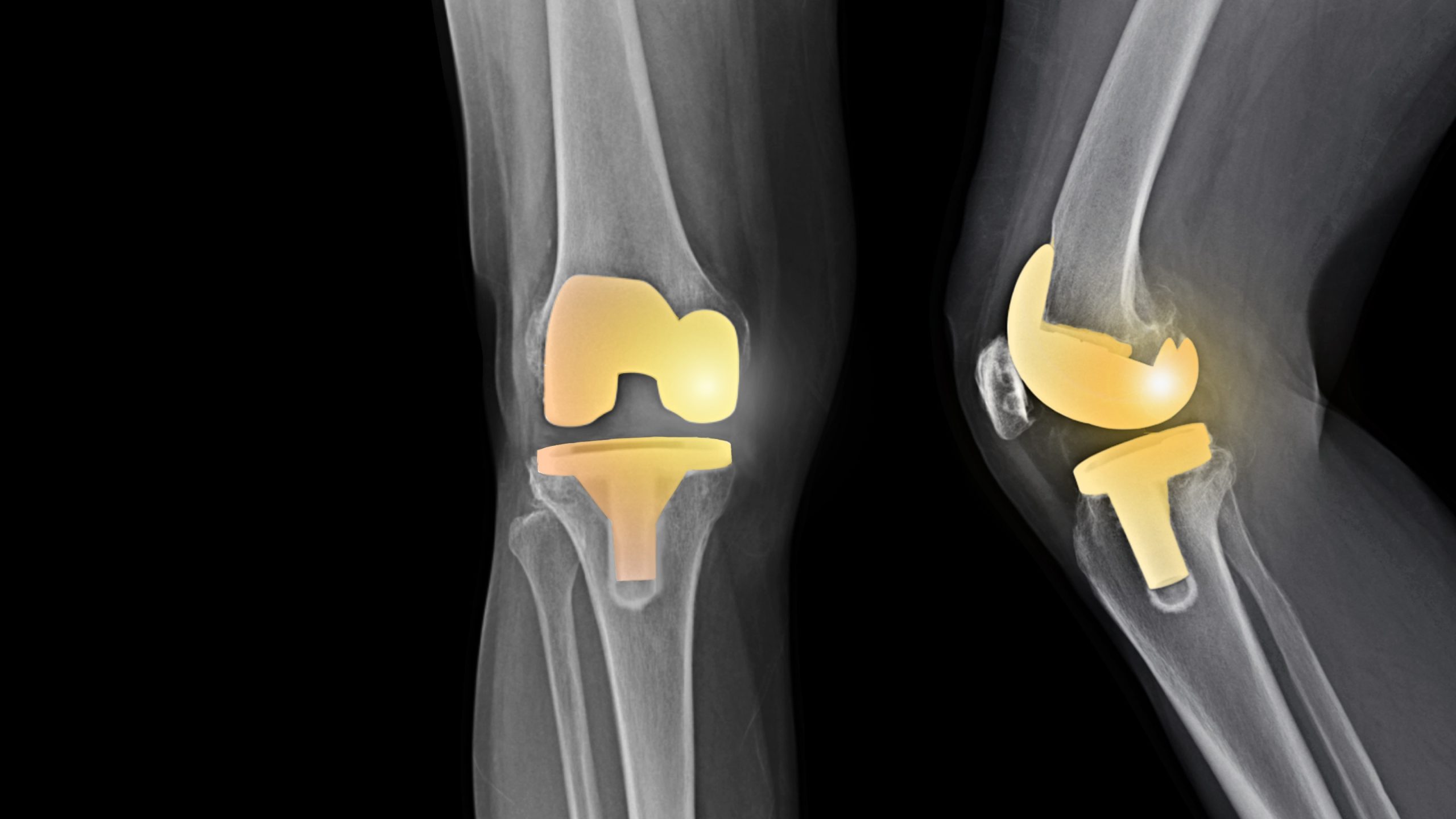 Hip & Knee Replacement Device Company Issues Class II Recall