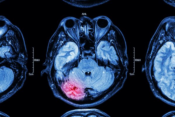 MRI scan of traumatic brain injury