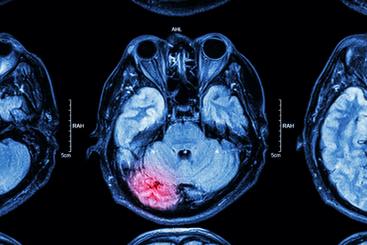 MRI scan of traumatic brain injury