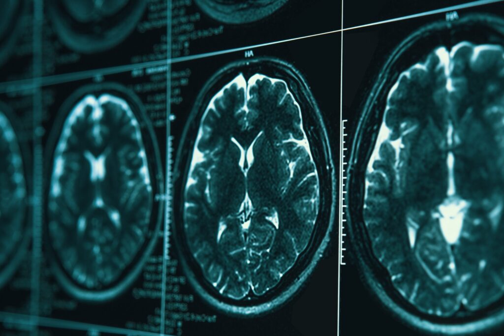 Several brain scans, backlit in a doctor's office. 