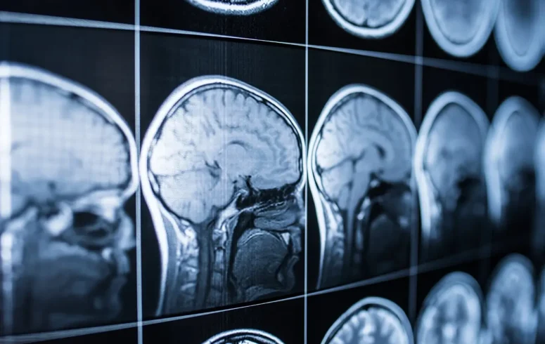 brain injury scans