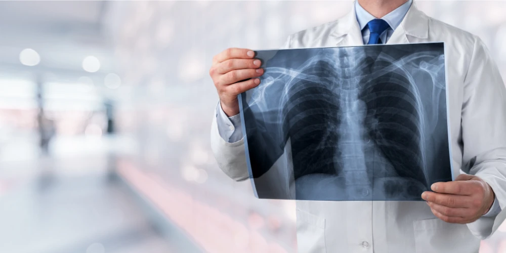 A male doctor holding an x-ray of a patient's chest, inspecting it for lung cancer.